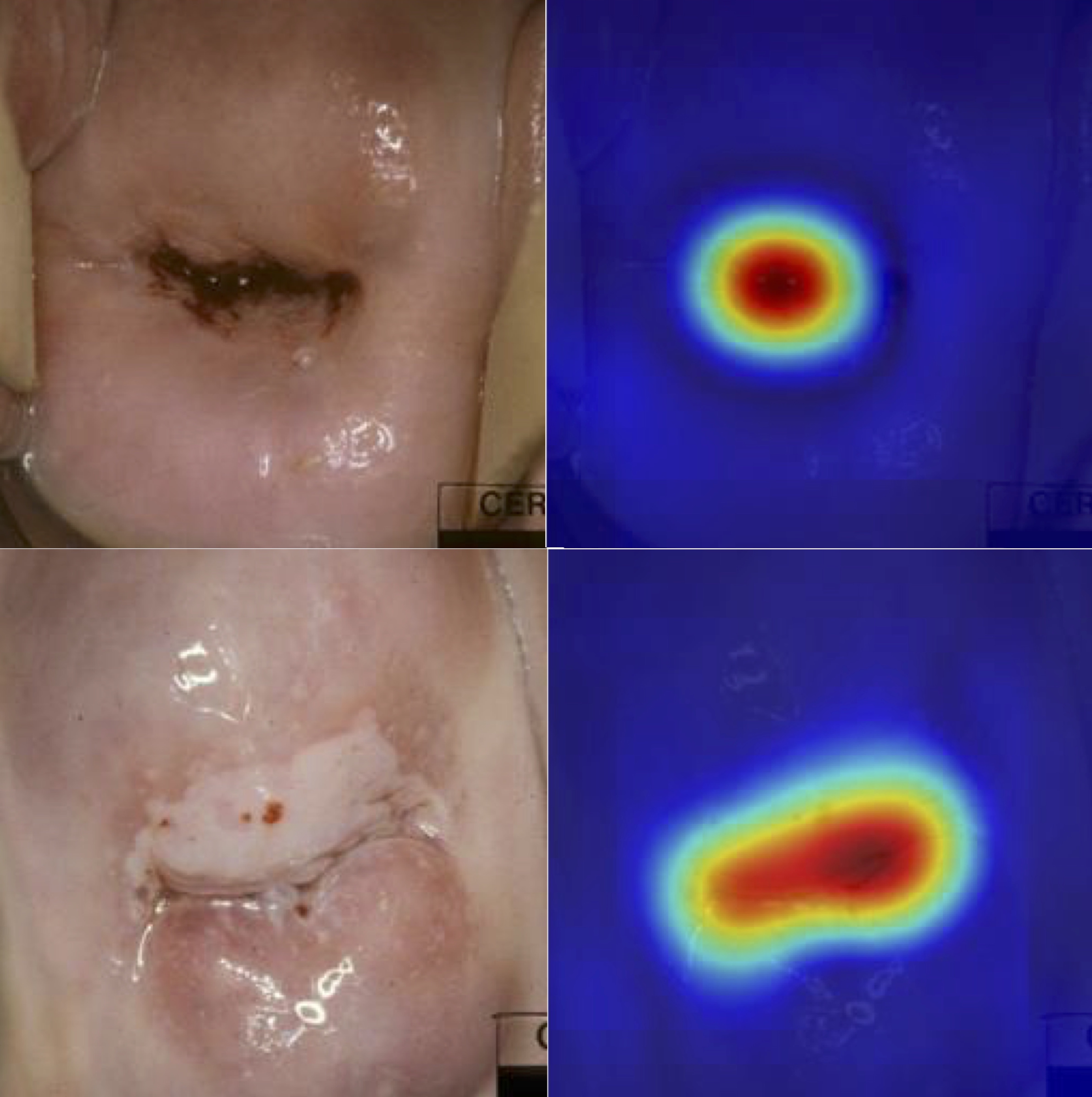 În stânga, imaginile arată leziuni precanceroase recunoscute corect de algoritmul computerizat. În dreapta, sunt reprezentate hărțile de „căldură” corespunzătoare, generate automat
