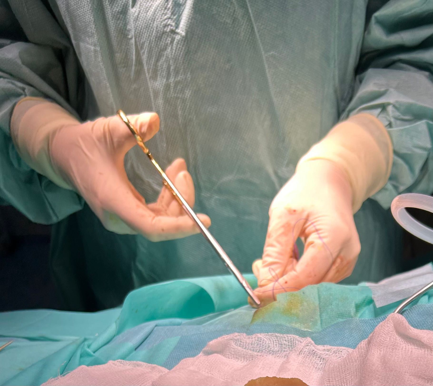 Tânără de 29 de ani salvată prin operație pe creier pentru o tumoră cerebrală agresivă și de mari dimensiuni la Spitalul Județean Arad