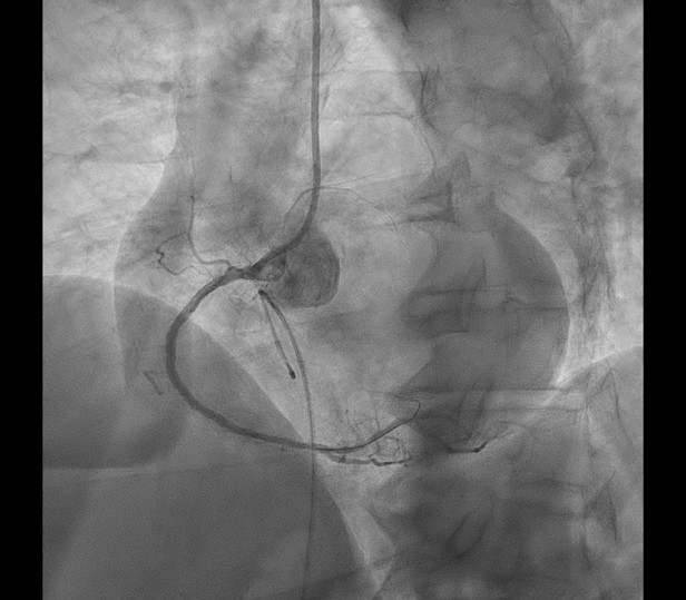 SJU Miercurea Ciuc a realizat primele intervenții de aterectomie orbitală pentru pacienții cu calcificări severe ale arterelor coronare