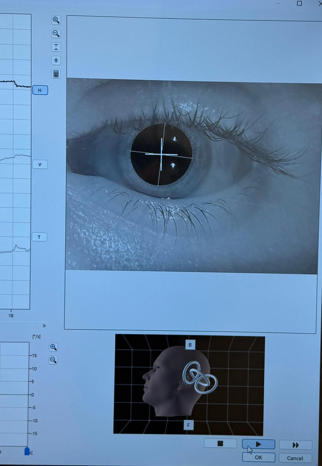 SCJU Bihor a devenit singurul centru din județ dotat cu tehnologia VERTI GOGGLES pentru diagnosticul vertijului și afecțiunilor vestibulare
