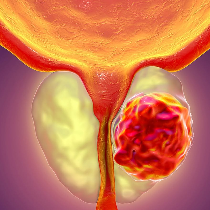 11 iunie – Ziua Mondială de Luptă Împotriva Cancerului de Prostată