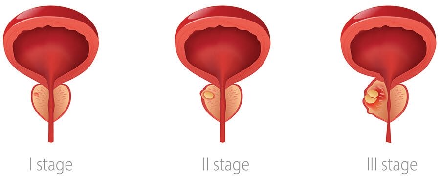 Asociația OncoHelp: Cancerul de prostată este cea mai frecventă formă de cancer la bărbații din România, depășind cancerul pulmonar și colorectal