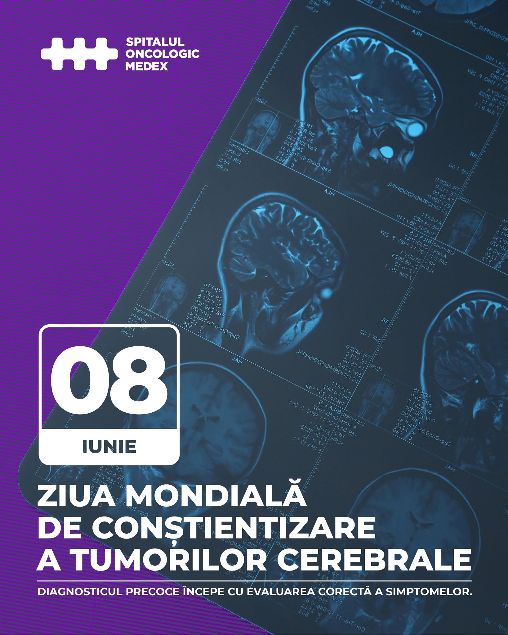 8 iunie – Ziua Mondială de Conștientizare a Tumorilor Cerebrale
