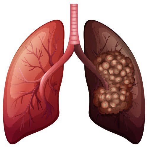 Asociaţia OncoHelp: Tratamentul cancerului pulmonar a evoluat major în ultimul deceniu prin terapii personalizate