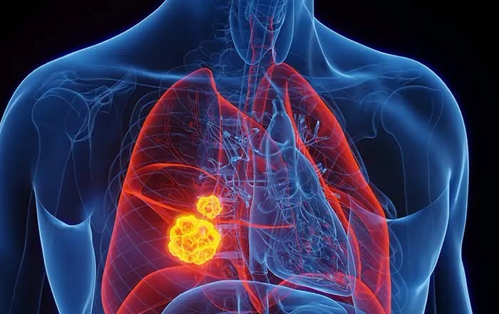 1 august – Ziua Mondială de Luptă Împotriva Cancerului Pulmonar