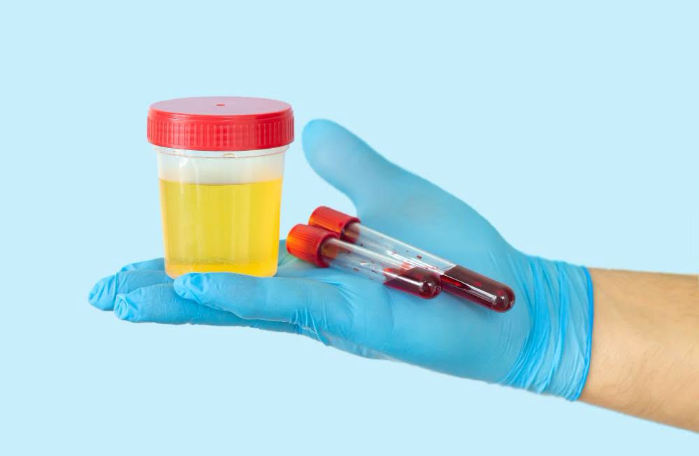 Spitalul Clinic CF Timișoara: Un simplu examen de urină poate indica infecții urinare, diabet și afecțiuni renale