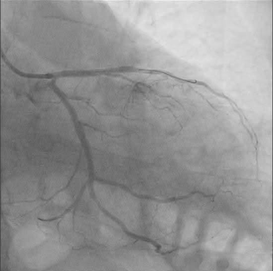 Angioplastie coronariană complexă la un pacient critic, realizată cu succes la Spitalul Sf. Pantelimon din București