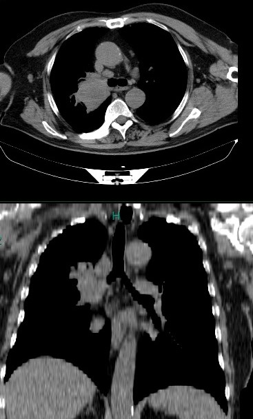 Comisia de Pneumologie a CMR: Metodologia națională de screening pentru cancerul pulmonar, elaborată și avizată