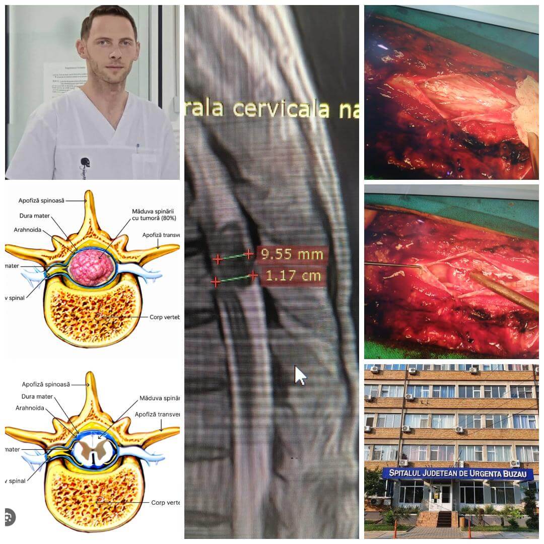 Premieră medicală la Spitalul Județean Buzău: Intervenție chirurgicală pentru rezecție formațiune tumorală toracală