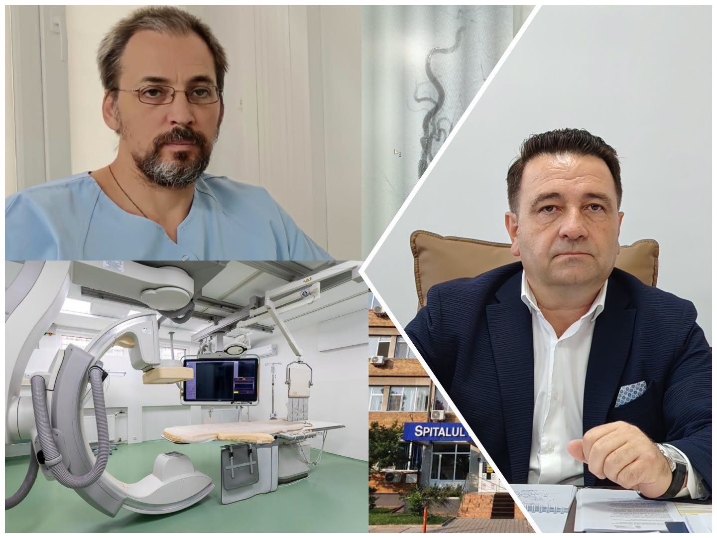 Angioplastie carotidiană realizată în premieră la Spitalul Județean Buzău pentru o pacientă cu stenoză severă de peste 90%