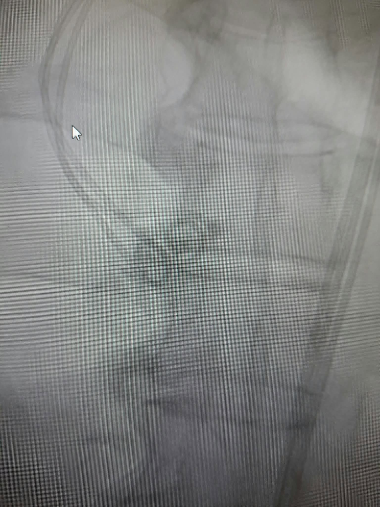 Premieră la Floreasca: Intervenție TAVI de urgență la un pacient cu stenoză aortică severă și șoc cardiogen