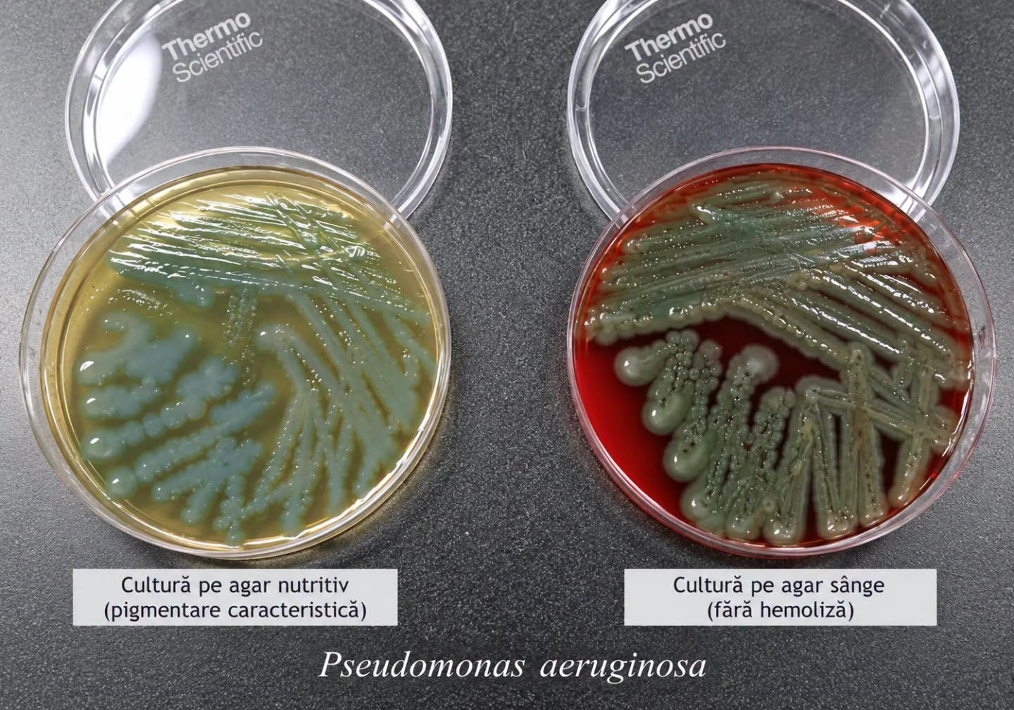 Prof. univ. dr. Valeriu Gheorghiță: Cefepimă sau piperacilină-tazobactam în pneumonia cu Pseudomonas aeruginosa? Rezultatele unui nou studiu