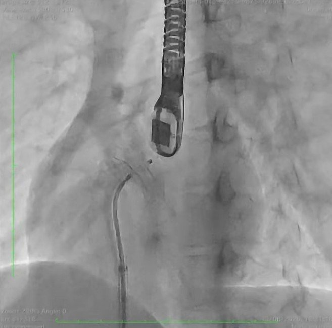 Spitalul Prof. Dr. Agrippa Ionescu” începe programul pentru tratamentul intervențional al cardiopatiilor congenitale la adulți